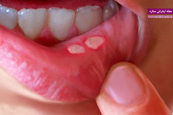 	درمان خانگی زخم دهان (درمان آفت دهان با طب سنتی) | وب 