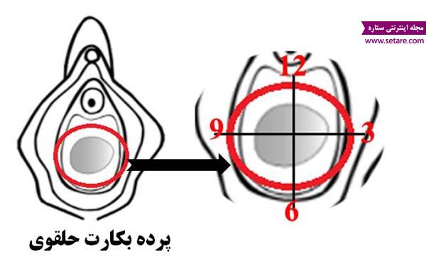 	آسیب دیدگی پرده بکارت حلقوی چگونه است؟ | وب 