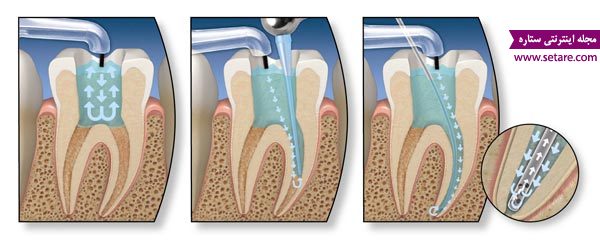 	عصب کشی دندان و علل درد پس از آن چیست؟ | وب 