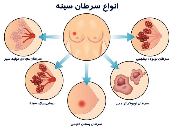 	علائم اولیه و نشانه های سرطان سینه چیست؟ | وب 