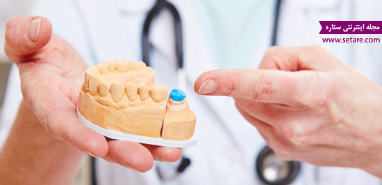 	هزینه و قیمت روکش دندان چقدر است؟ | وب 