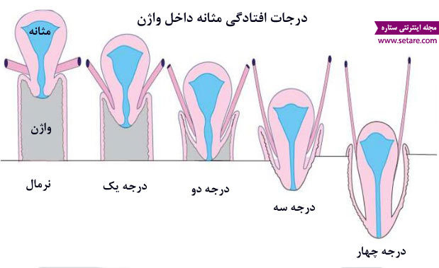 	علت و علائم افتادگی مثانه چیست و چگونه درمان می‌شود؟ | وب 