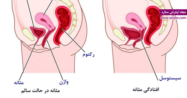 	علت و علائم افتادگی مثانه چیست و چگونه درمان می‌شود؟ | وب 