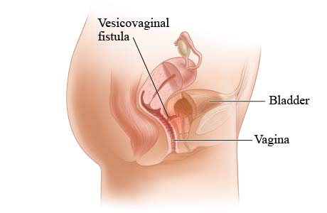 	فیستول واژن چیست؟ + علت، علائم و راه های درمان