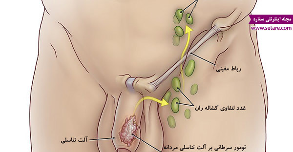 	سرطان آلت تناسلی مردان چیست؟ + علت، علائم و راه های درمان | وب 