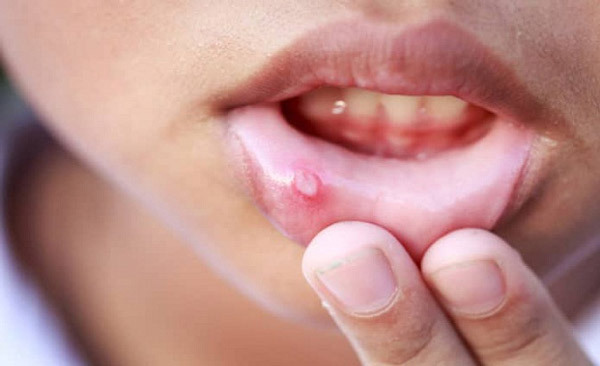 آفت دهان چیست؟ راه های درمان خانگی و دارویی | وب 