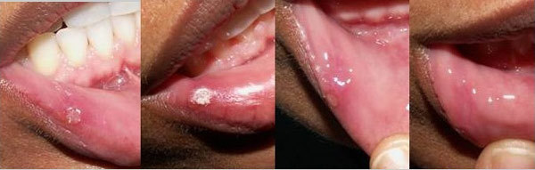 آفت دهان چیست؟ راه های درمان خانگی و دارویی | وب 