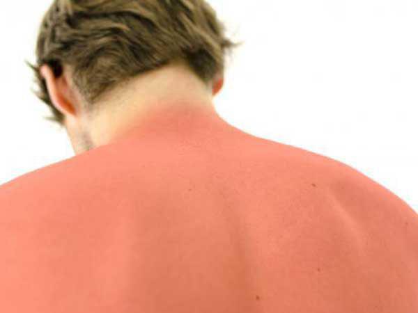 	آفتاب سوختگی چیست و چطور درمان می شود؟ | وب 