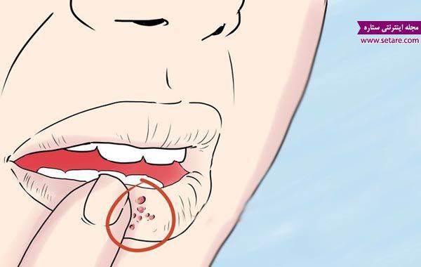 	قرص تبخال درمانی برای تبخال لب و دهان | وب 