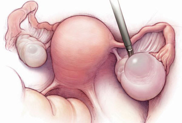 درمان کیست تخمدان با قرص ال دی (LD)