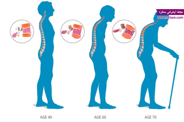 	پوکی استخوان چیست؟ + علل و راه های درمان