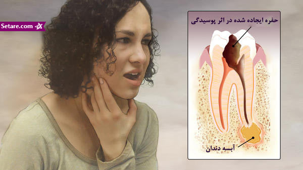 	آبسه دندان چیست؟ + درمان آبسه دندان (درمان خانگی آبسه دندان)