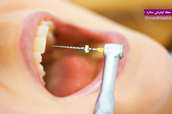 	نکروز دندان یا مرگ دندان چیست؟