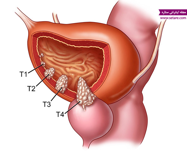 	سرطان مثانه (راه‌های تشخیص، علت، علائم، رژیم غذایی و درمان آن) | وب 