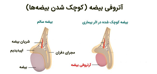 علت و علائم آتروفی بیضه چیست؟ | وب 