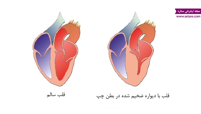 	علت ضخیم شدن دیواره قلب چیست و چگونه درمان می‌شود؟ | وب 
