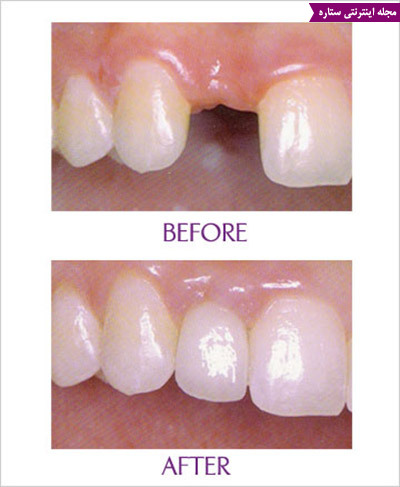 	ایمپلنت دندان جلو و تاثیر آن در زیبایی | وب 