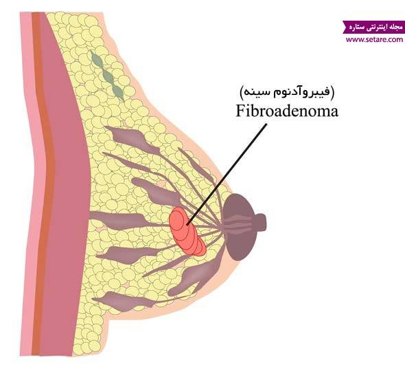 	علائم سرطان سینه چیست؟