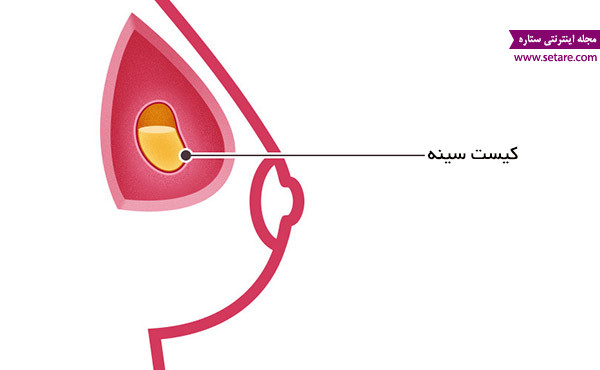 	علائم سرطان سینه چیست؟ | وب 