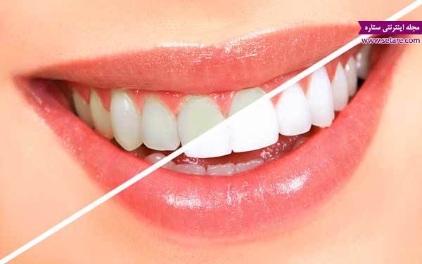 	آنچه باید درباره سفید کردن دندان و جرم‌گیری دندان بدانید