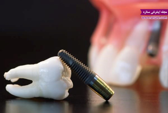 	ایمپلنت دندان چه مزایا و معایبی دارد؟