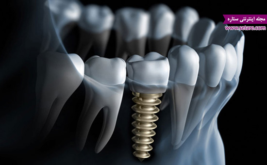 	ایمپلنت دندان چه مزایا و معایبی دارد؟ | وب 