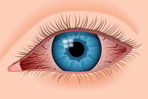 علت قرمزی چشم چیست و چگونه درمان می‌شود؟