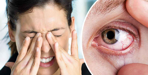 علت قرمزی چشم چیست و چگونه درمان می‌شود؟ | وب 