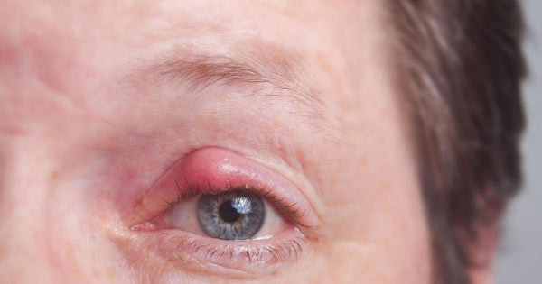 علت قرمزی چشم چیست و چگونه درمان می‌شود؟ | وب 