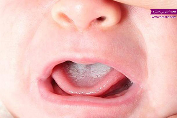 	برفک دهان چیست و چگونه درمان میشود؟