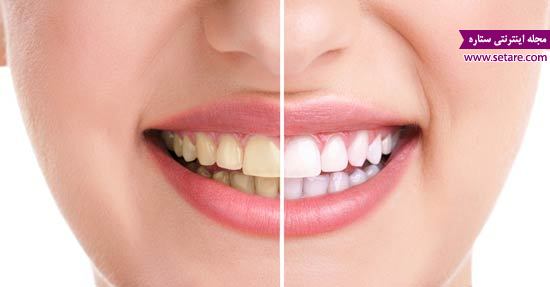 	بلیچینگ دندان چیست؟ - سفید کردن دندان به روش بلیچینگ | وب 
