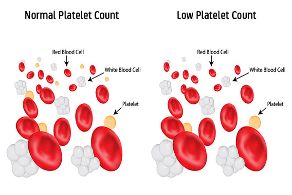 	پایین بودن پلاکت خون چه علائم و عواقبی دارد؟