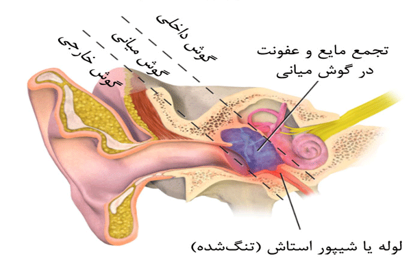 	عفونت گوش داخلی و احساس سرگیجه | وب 