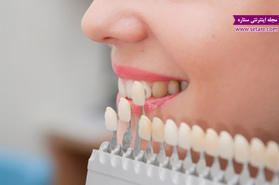 	روکش دندان و هر آنچه که درباره آن باید بدانید | وب 