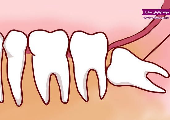 	جراحی دندان عقل نهفته چگونه است؟