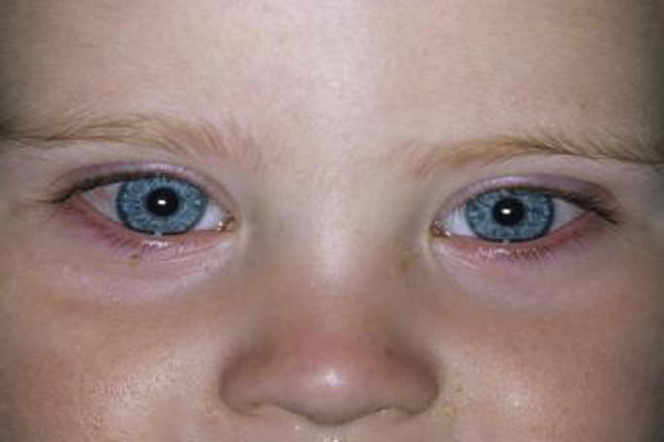 قی کردن چشم نوزاد؛ بیماری چشم صورتی (التهاب ملتحمه) در کودکان