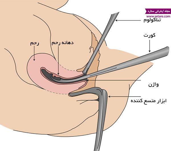 	پاسخ به سوال های متدوال در مورد عمل کورتاژ | وب 