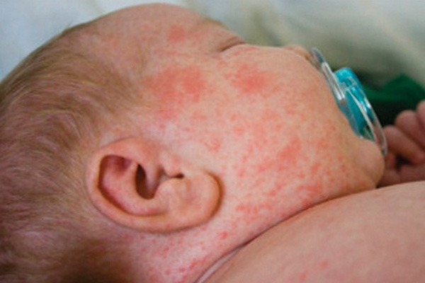 واکسن 12 ماهگی کودکان، علیه چه بیماری‌هایی تزریق می‌شود؟