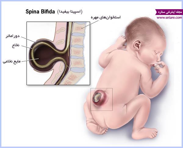 	اسید فولیک چیست؟ + لزوم مصرف اسید فولیک در دوران بارداری