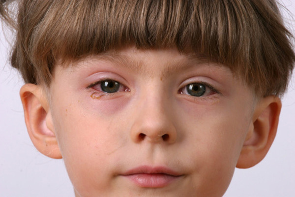 در زمان عفونت چشم نوزادان و کودکان چه کنیم؟ | وب 