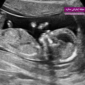 	هفته سیزدهم بارداری - ورود به سه ماهه دوم بارداری | وب 