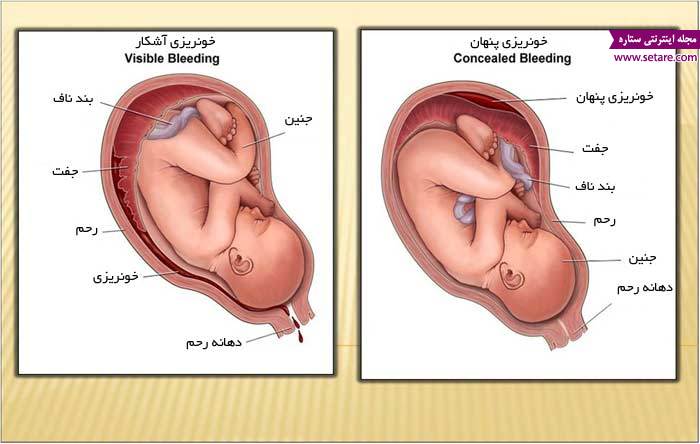 	علت و علائم جدا شدن زودرس جفت چیست؟