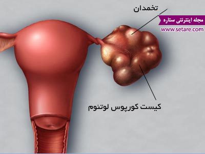 	کیست کورپوس لوتئوم یا کیست جسم زرد در بارداری چیست؟