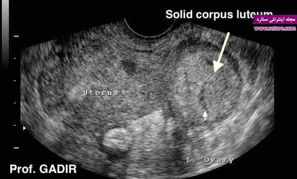 	کیست کورپوس لوتئوم یا کیست جسم زرد در بارداری چیست؟ | وب 