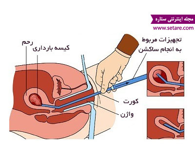 	عمل کورتاژ جنین چیست و چگونه انجام می شود؟ + عوارض کورتاژ | وب 