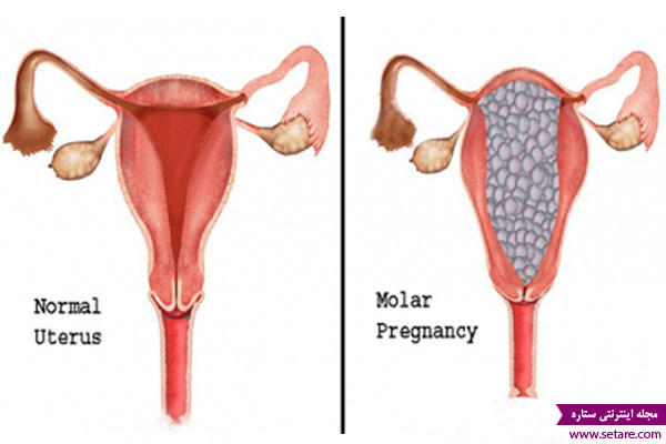 	علت، علایم و درمان حاملگی مولار یا بچه خوره
