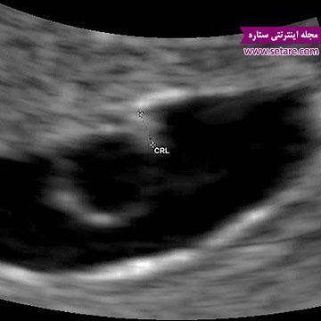 	هفته پنجم بارداری - نوسانات خلقی زنان در هفته پنجم باردرای