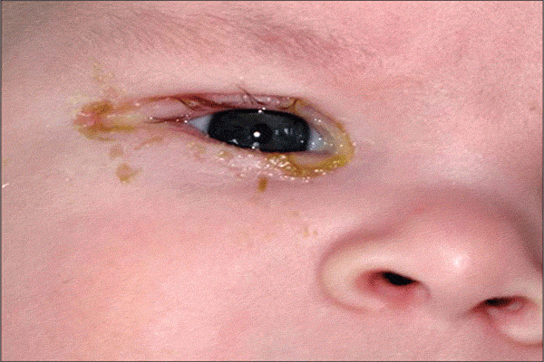 	علت قرمزی چشم نوزاد چیست؟ (راه‌های درمان) | وب 