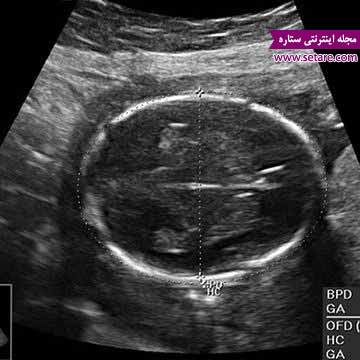 	هفته هجدهم بارداری - انجام سونوگرافی برای تشخیص جنسیت جنین | وب 