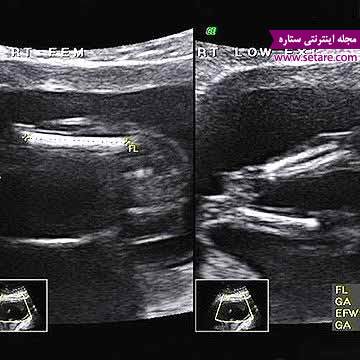 	هفته هجدهم بارداری - انجام سونوگرافی برای تشخیص جنسیت جنین | وب 